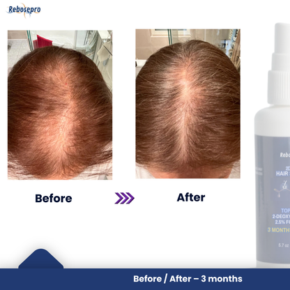 Deoxyribose Sugar Gel for Thinning Hair & Hair Loss - 5.7 oz