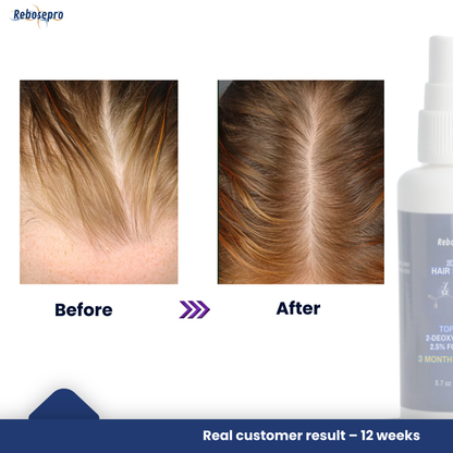 Deoxyribose Sugar Gel for Thinning Hair & Hair Loss - 5.7 oz